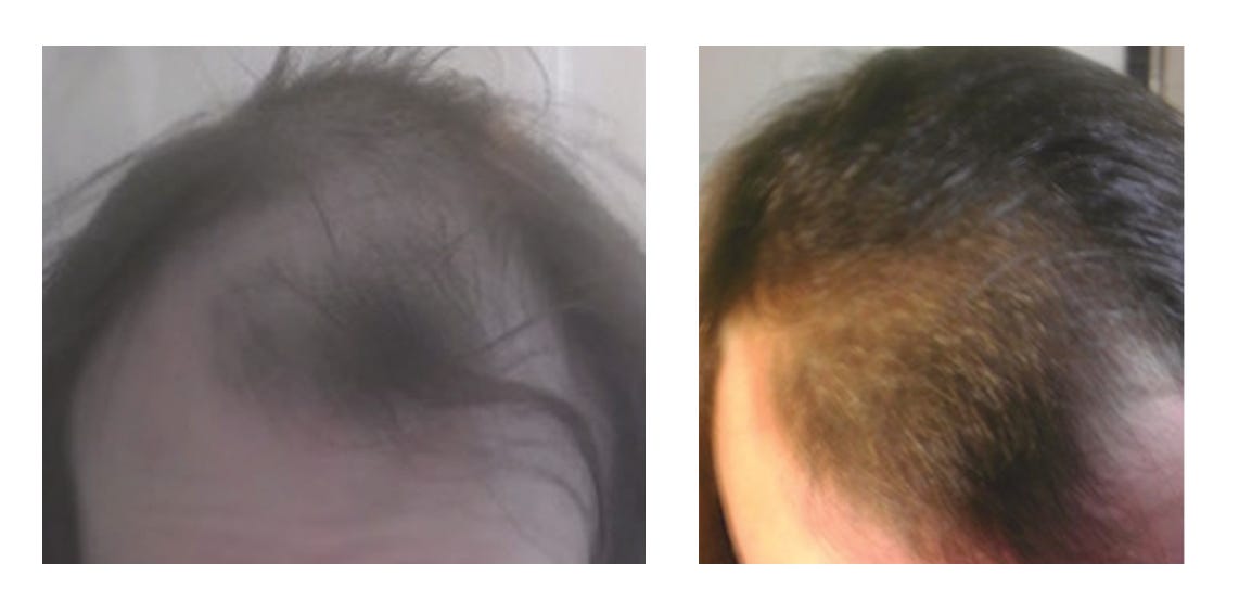 Two pictures of scalp hair. On the left, there is a great deal of androgenic alopecia. On the right, six months later, is nearly full restoration.