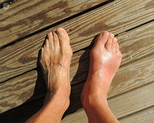 Gout attacks and management tips | Top Doctors