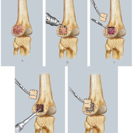 Surgery - GCT SUPPORT