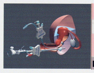Systematic Salpingoscopy and Microsalpingoscopy during Fertiloscopy -  ScienceDirect