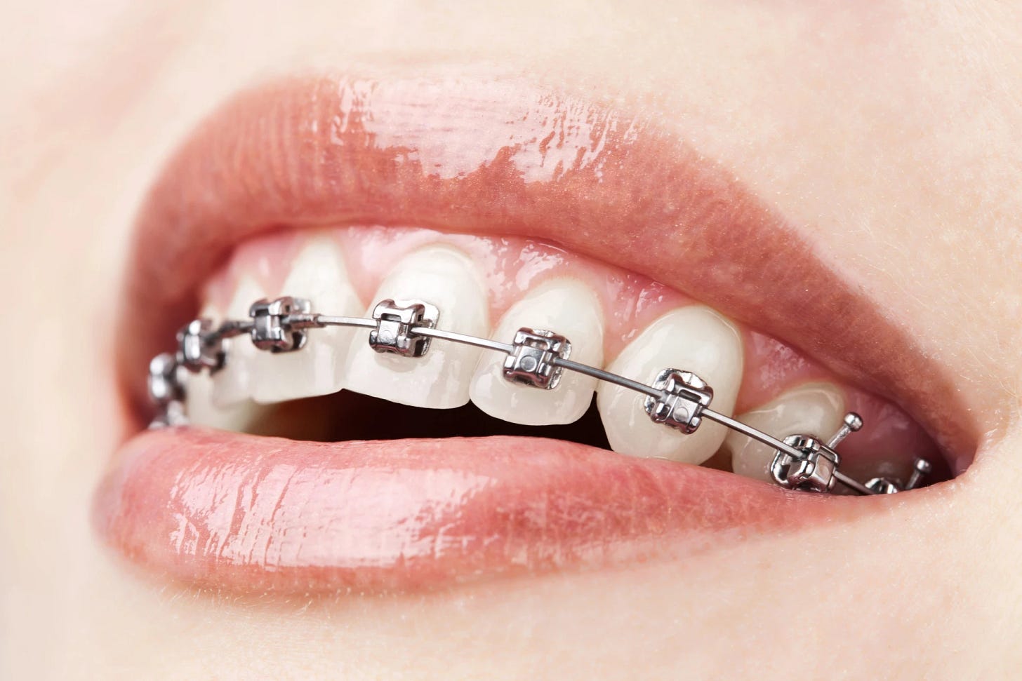 The Realm of Orthodontics: All You Need to Know About Braces