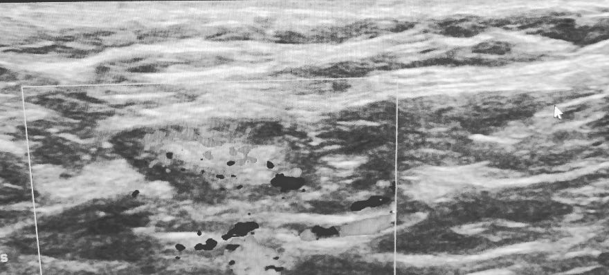 Ultrasound image of Lymph Nodes. 