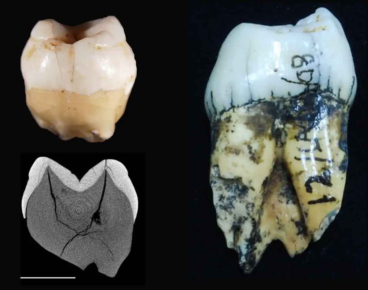 Image of two teeth and a CT cross-section of one of them Image of two teeth and a CT cross-section of one of them