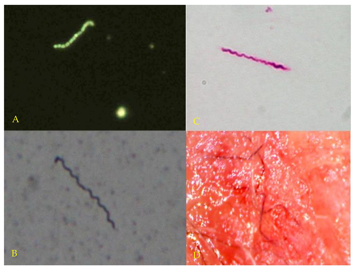 Healthcare | Free Full-Text | Persistent Borrelia Infection in Patients  with Ongoing Symptoms of Lyme Disease