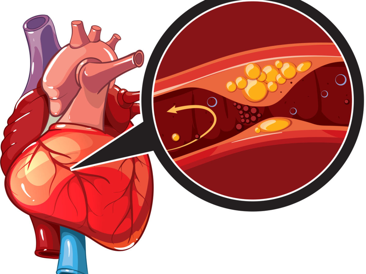 Coronary Artery Disease: Treatment, Causes & Prevention