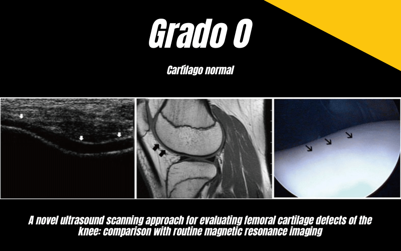 3. Ecografia Tempo formacion Cartilago Femoral.png