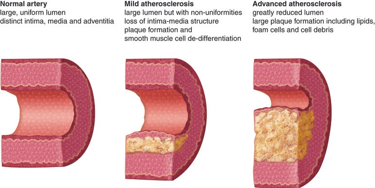 atherosclerosis progression