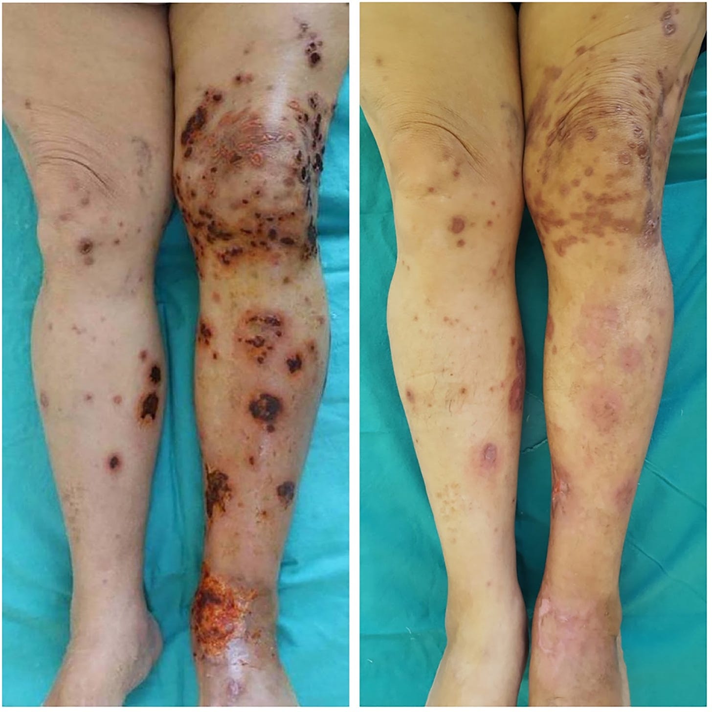 Fusarium solani infection in a diabetic patient treated with itraconazole  and debridement - Karadağ - 2020 - Dermatologic Therapy - Wiley Online  Library