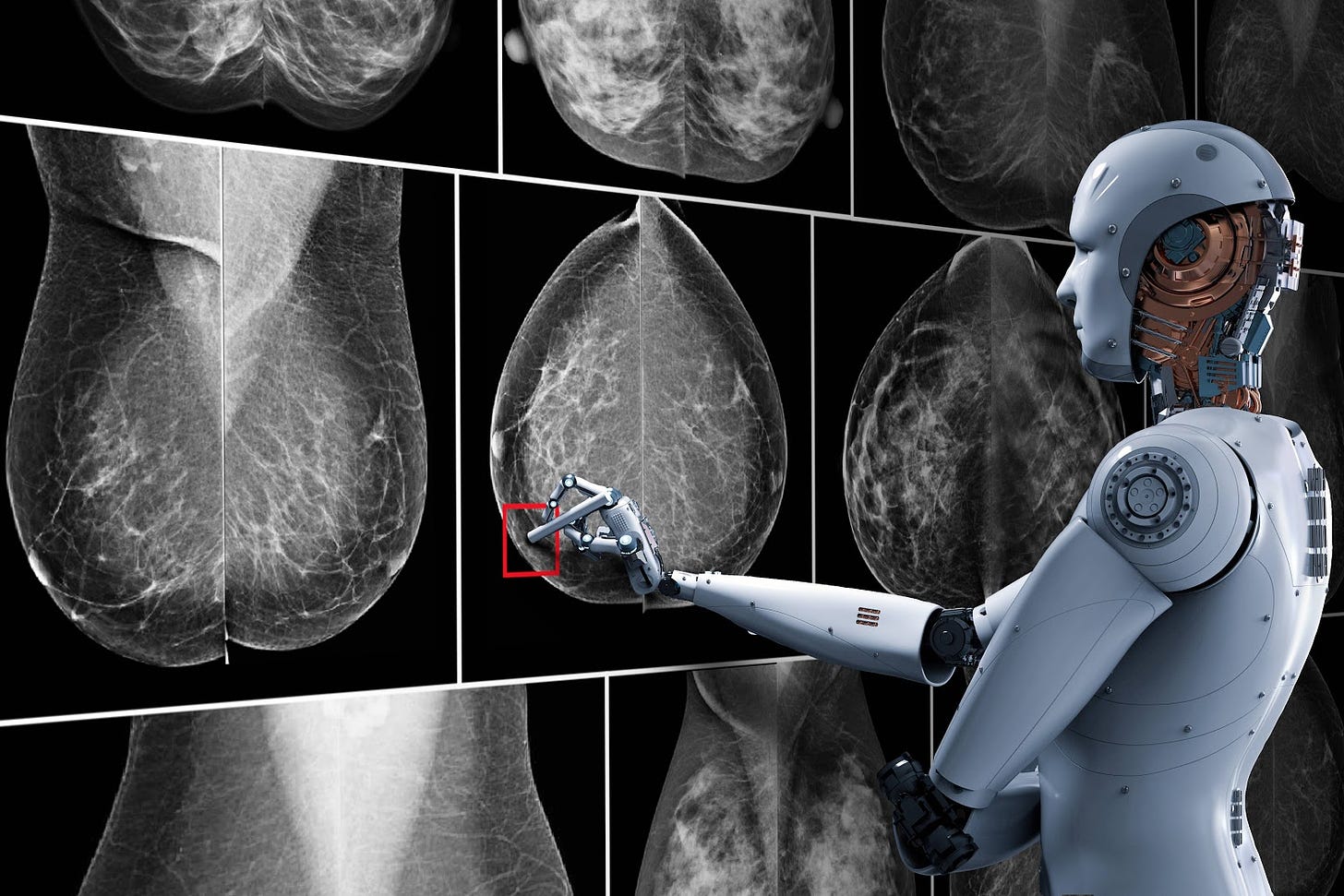 AI Improves Breast Cancer Diagnoses | NVIDIA Blog