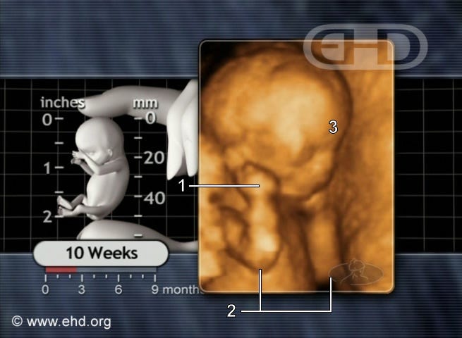 Ultrasound and drawing of preborn baby at 10 weeks, showing face, head, and arms