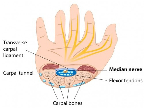 Carpal Tunnel Syndrome