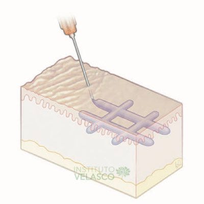 aplicação em cross-hatching ou em hashtag