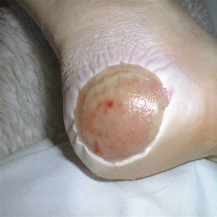 Maceración perilesional — piel blanca y arrugada por exudado mal gestionado