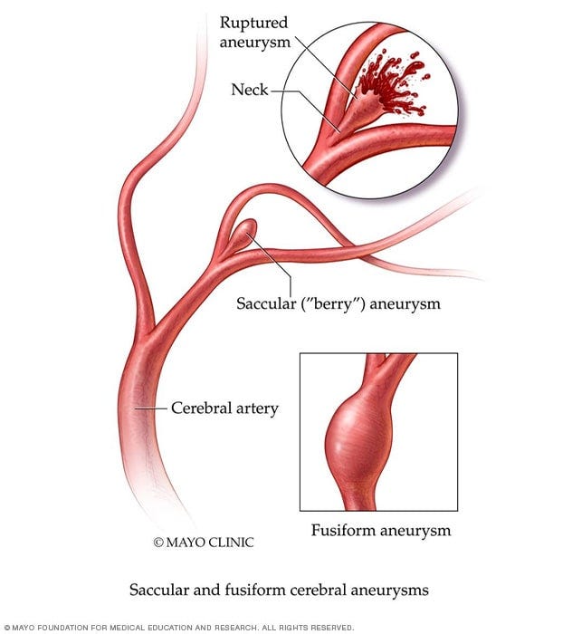 Brain aneurysm - Symptoms and causes - Mayo Clinic