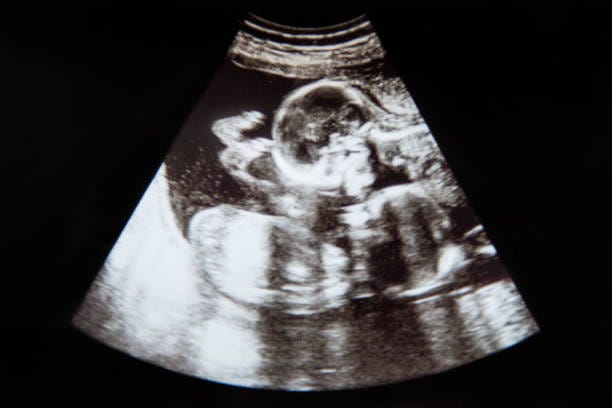 430+ Ultrasound Twins Stock Photos, Pictures & Royalty-Free Images - iStock  | Sonogram, Pregnancy, Triplets babies