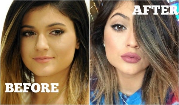 kylie jenner lip fillers 2015