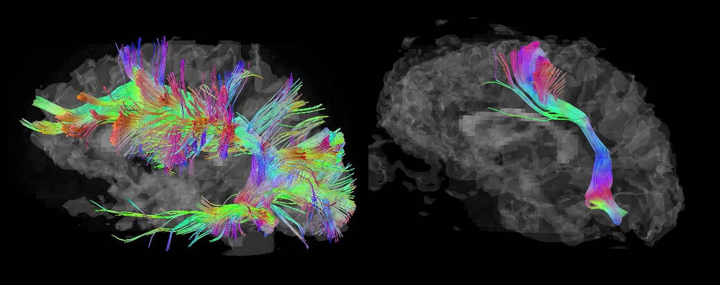 Two brain scans. The left (autistic) brain is a rainbow of multicolored connections covering most of the brain. The right (neurotypical) is a direct chain of information from brain stem to language center.