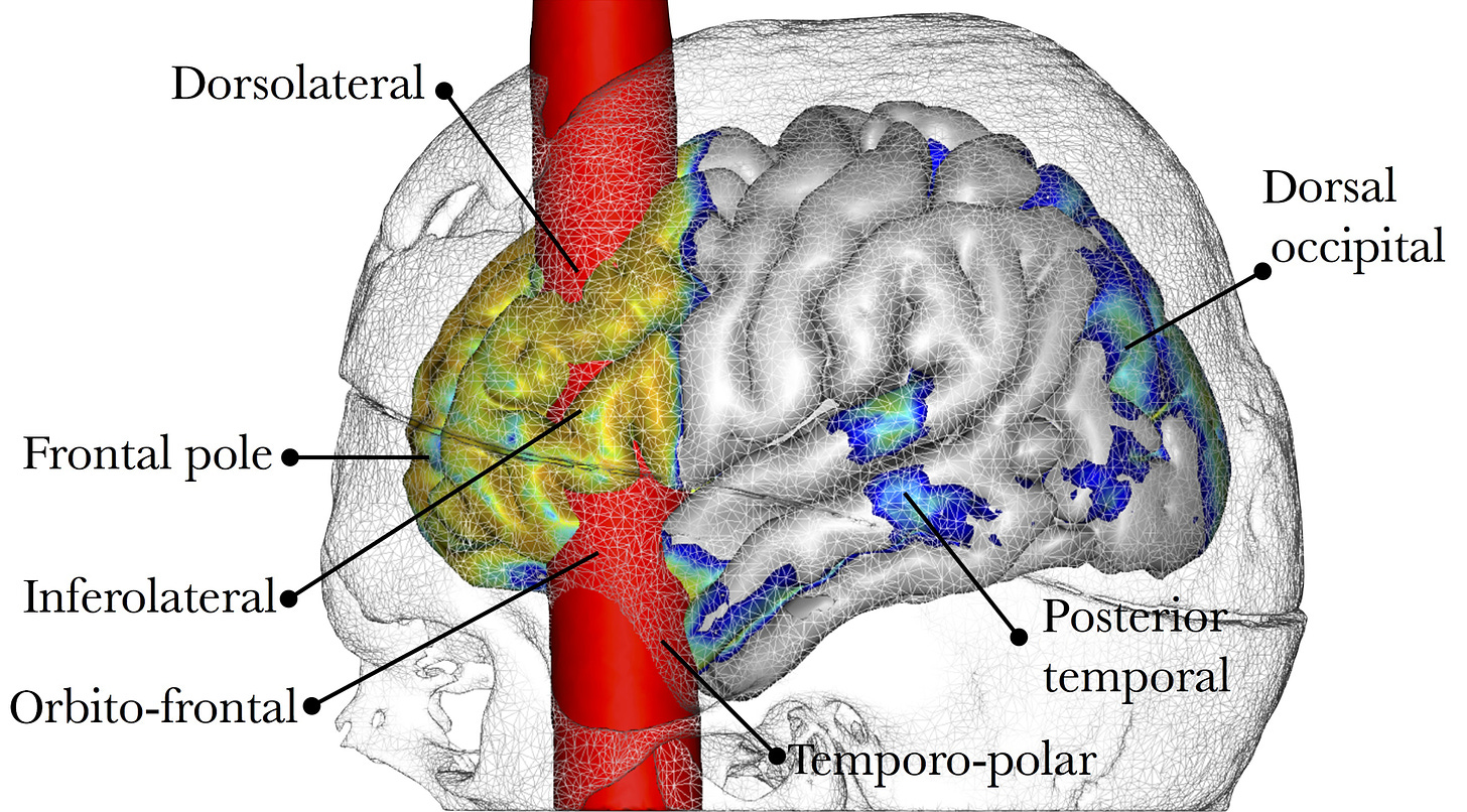 Image of reconstructed damage to brain of Phineas Gage