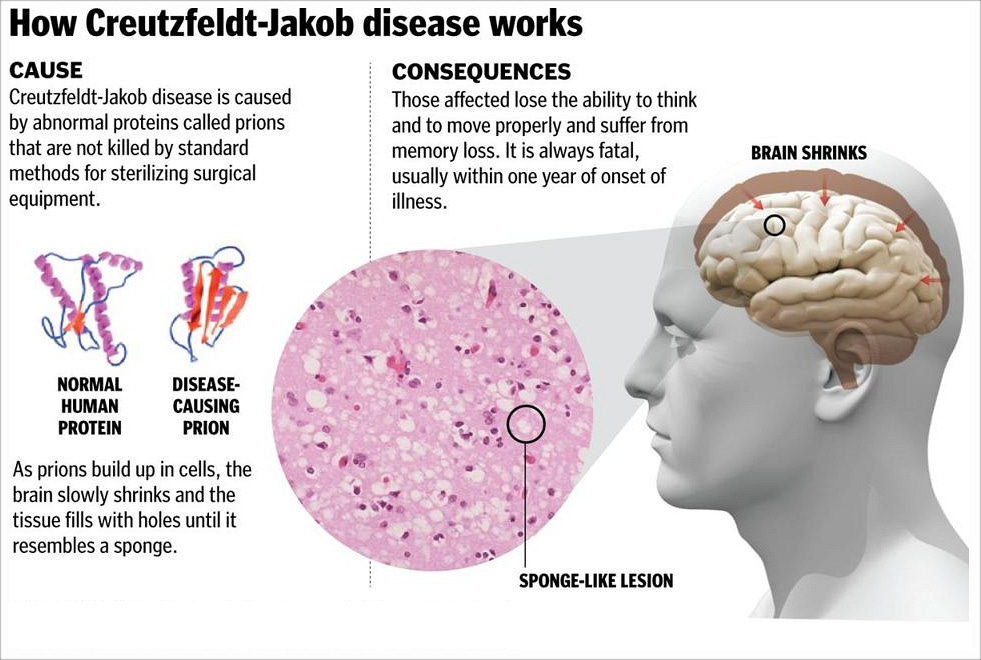 Creutzfeldt-Jakob Disease, CJD - Health And Medical Information