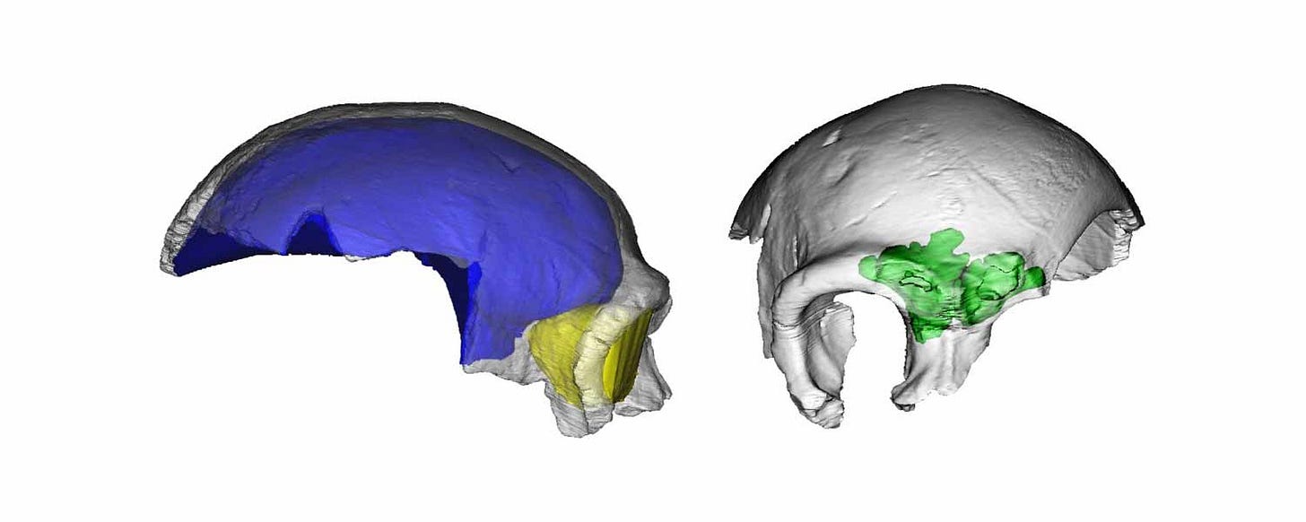Left, lateral view of CT rendering, right frontal view Left, lateral view of CT rendering, right frontal view