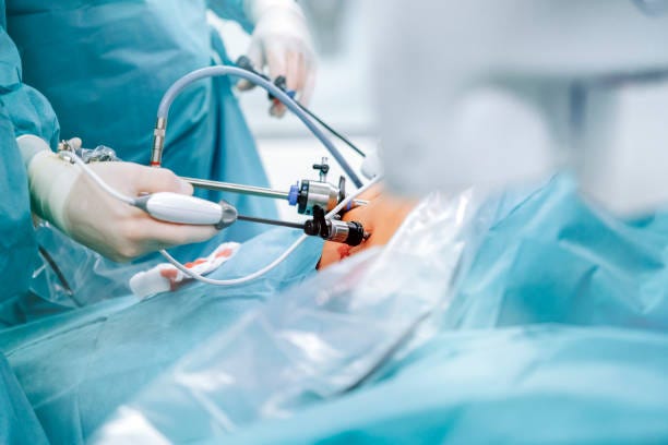 5,100+ Laparoscopic Surgery Stock Photos, Pictures & Royalty-Free Images -  iStock | Laparoscopic surgery equipment, Laparoscopic surgery kidney, Laparoscopic  surgery illustration