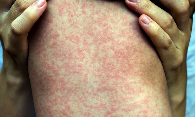 Measles | NHS inform