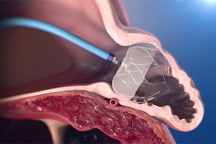 LAA Occluder PREVAILs in Cost-Effectiveness | MedPage Today