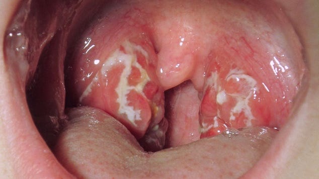 Tonsillitis vs. strep throat: How to tell the difference