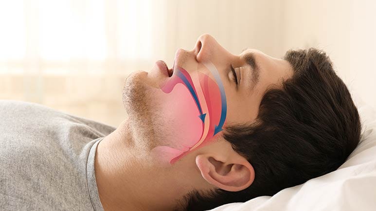 snoring obstructive sleep apnea