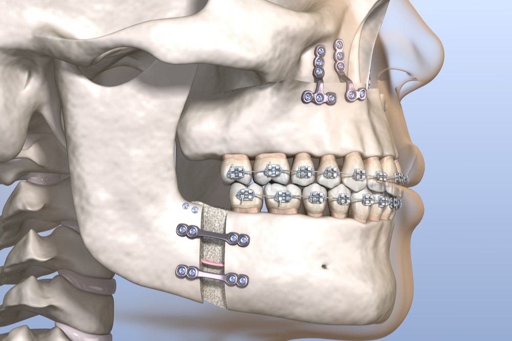 Double jaw surgery Double jaw surgery