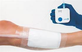 Dispositivo de terapia de presión negativa (TPN/VAC)