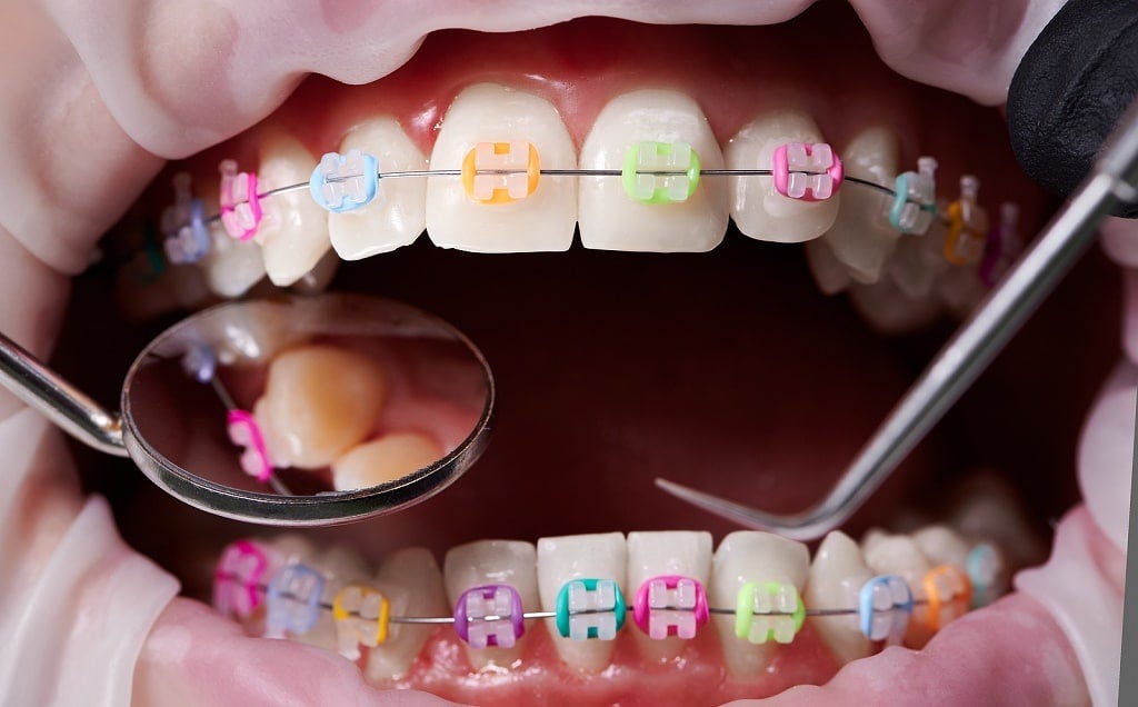 What Are Orthodontics And Who Provides Them In Saskatoon - Boulevard Dental