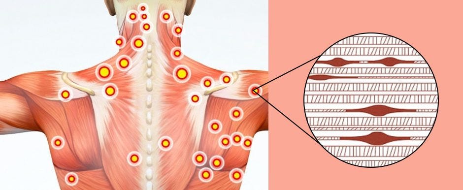 Novice Guide to Pressure Points and Myofascial Trigger Points -  NYDNRehab.com