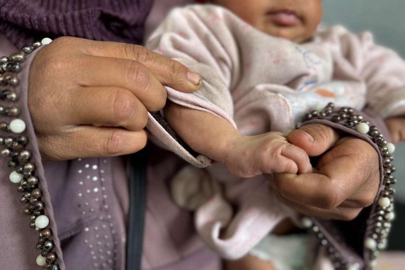 A mother holds her baby's hand that has a skin condition in Gaza. 