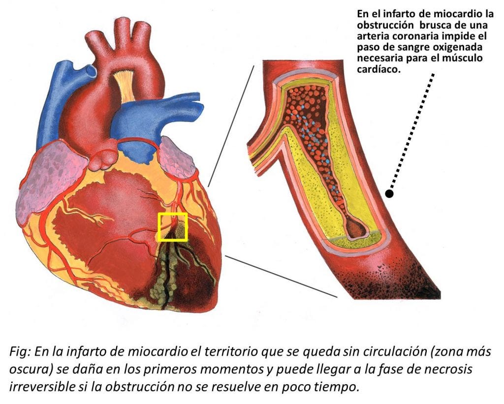 Qué es el infarto agudo de miocardio?