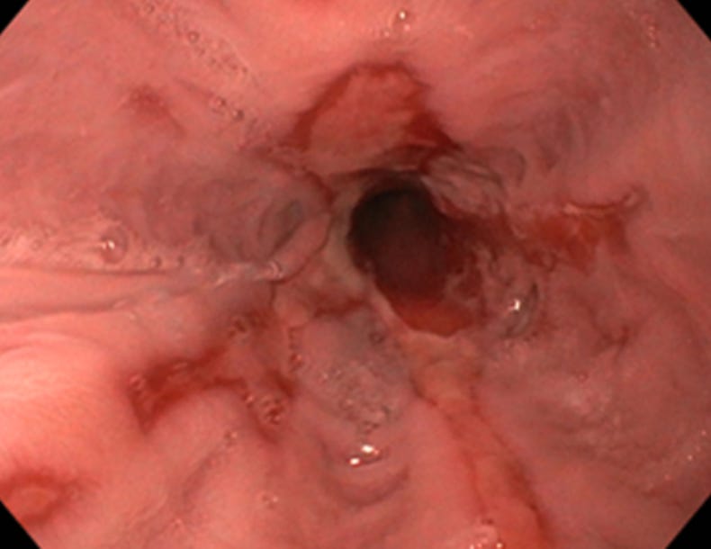 Oesophagitis