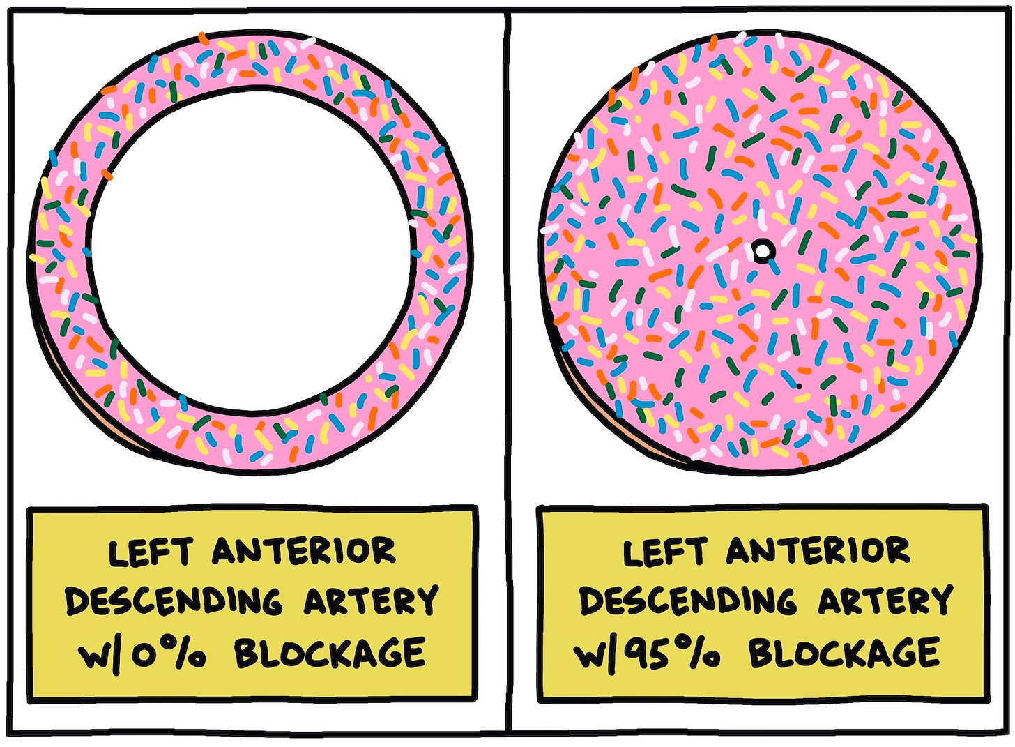 drawing of arteries as donuts, one with 0 percent blockage, one with 95 percent blockage