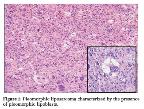 pleomorphic sarcoma