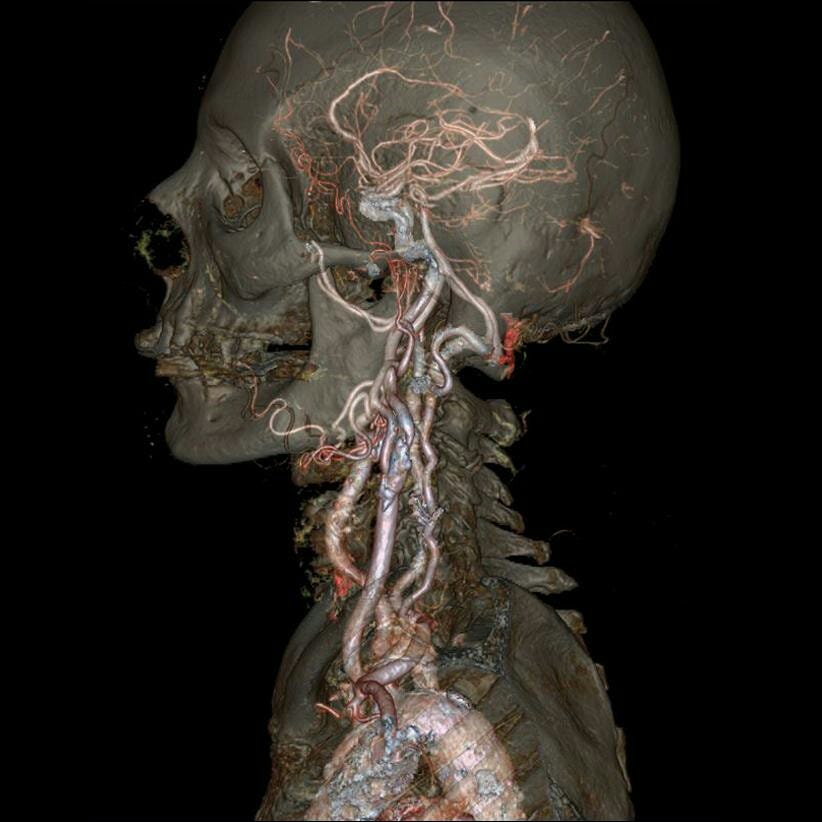 A high-resolution left transverse arteriogram of the upper thorax and skull.