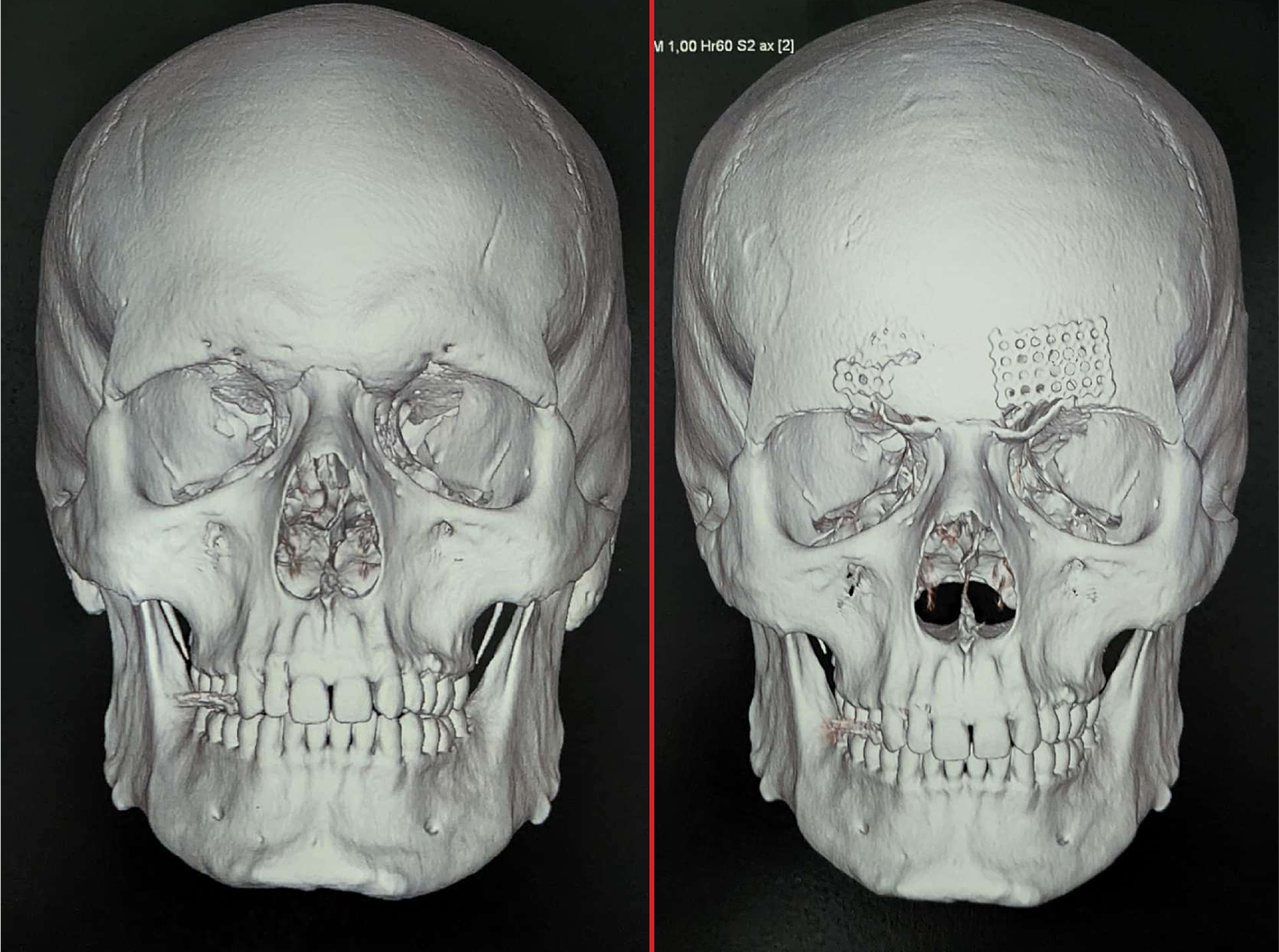 Two side-by-side CT scans. THe left, before FFS, has a very pronounced brow ridge and drooping orbital sockets. The right, after, has neither.