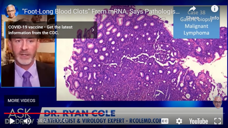 Dr. Ryan Cole shows a lymphoma at the stomach lining slide following the COVID-19 shots at the 36:30 mark on the Ask Dr. Drew show. 