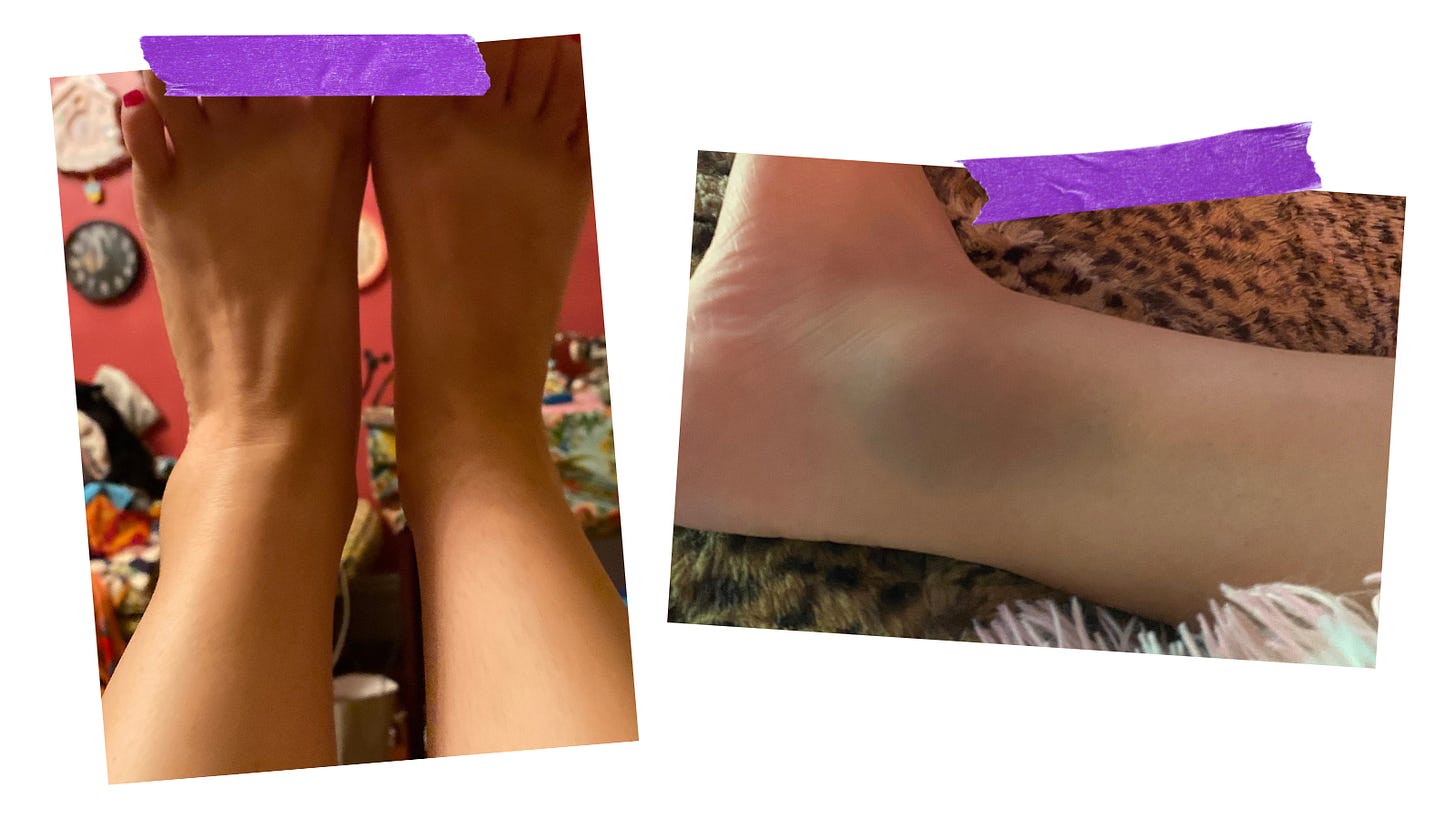 Two images of Chloe’s sprained ankle, which is blue and bulging. 