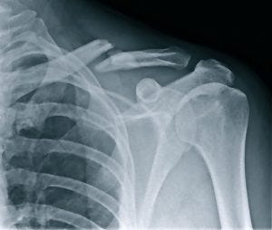 2012-04-16 collar-bone-xray medium