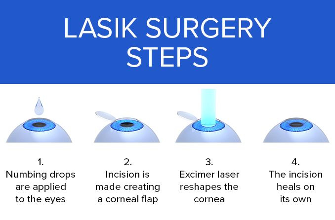 LASIK Surgery: Definition, Procedure, Results