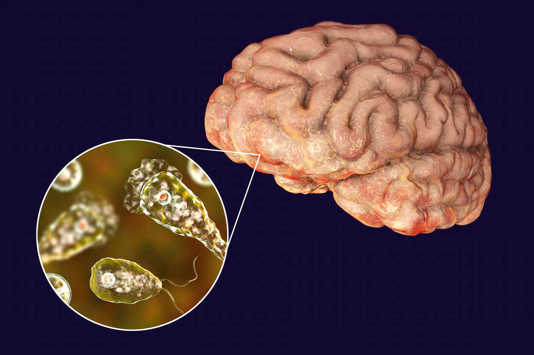Brain-eating amoeba Naegleria fowleri infections are rare but deadly : NPR