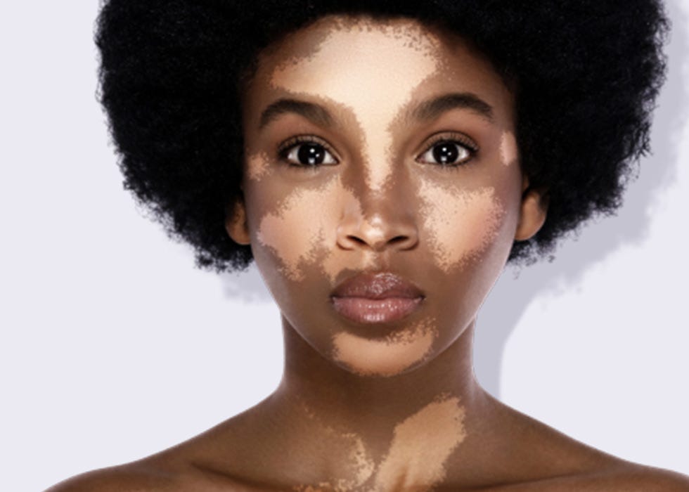 Vitiligo Causes & Treatments | Dermatology Inc.