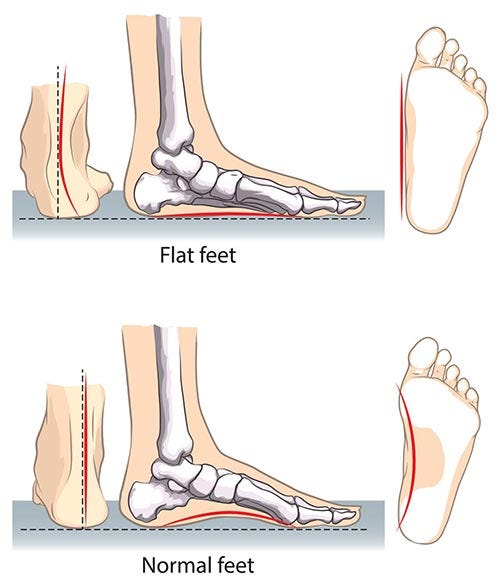 Flat Feet Correction Doctors in NYC | Manhattan Foot Specialists