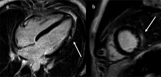 FIGURE 1. Cardiac MRI of patient 1. Four chamber (A) and short axis (B) postcontrast images depicting apical and midchamber lateral wall subepicardial late gadolinium enhancement (arrows). Pattern and distribution are highly characteristic for myocarditis.