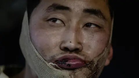 @ZelenskyyUa/X The image shows a close-up of man's face. He has a bloodied lip and bandage around his jaw and he is looking away from the camera @ZelenskyyUa/X The image shows a close-up of man's face. He has a bloodied lip and bandage around his jaw and he is looking away from the camera