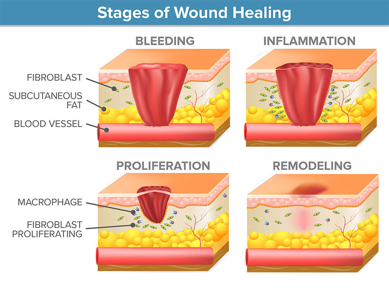 https://wasatchphotonics.com/wp-content/uploads/Wound-Healing-Stages-stacked.jpg